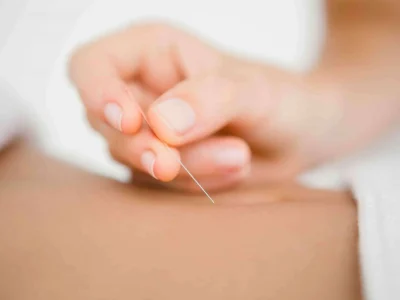 My Chiro, Dr. Aaron and Associates - Dry Needling